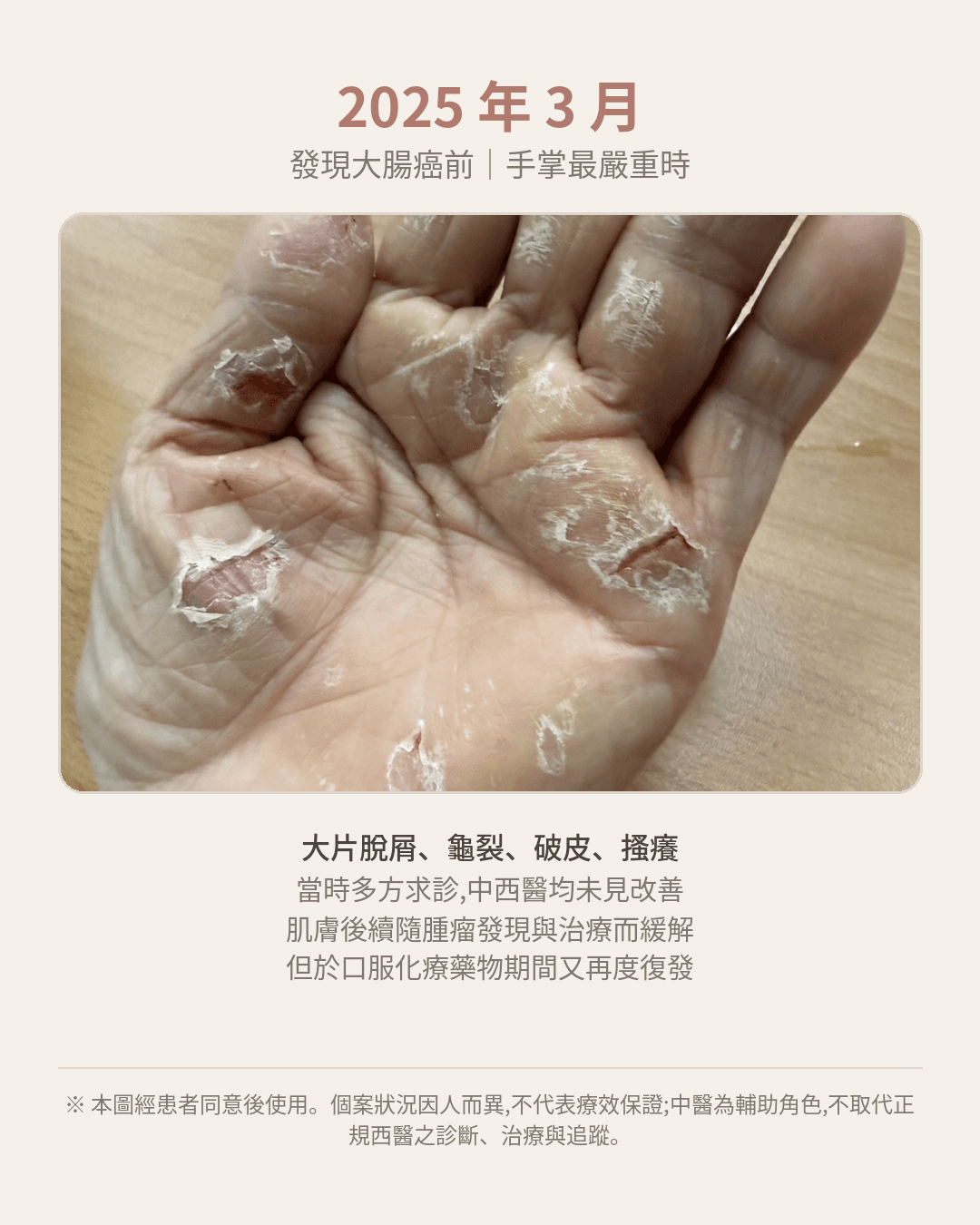 患者左手病灶。此為 2025 年腫瘤治療前。2026 年至中醫門診就診時的嚴重程度約為此圖的 6 成