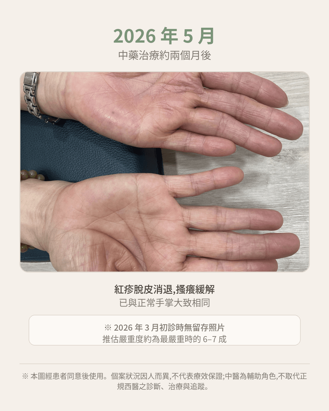 治療後雙手狀況